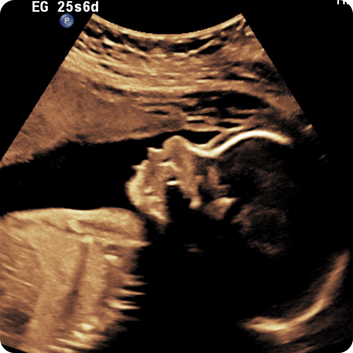 Eco Doppler Ecografia Obstetrica Trimestre Obstétrica Ecografia