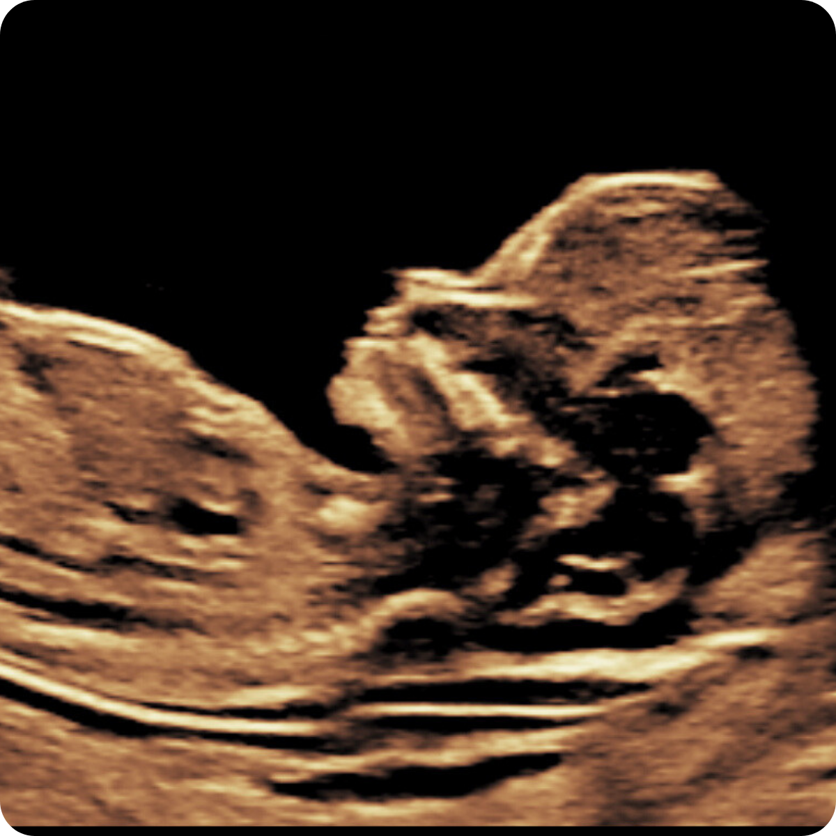 Ecografía Estudio Embarazo Sindrome Down Ecografía De Embarazo En