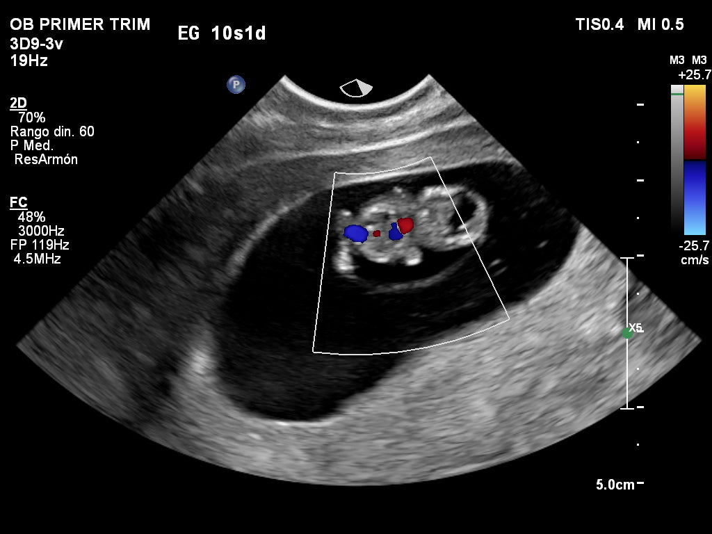 El Embarazo A Las Cuantas Semanas Se Hace La Segunda Ecografia